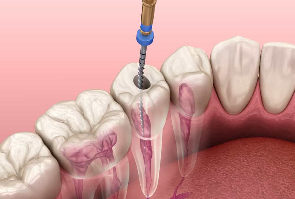 Instructies na een endodontische behandeling